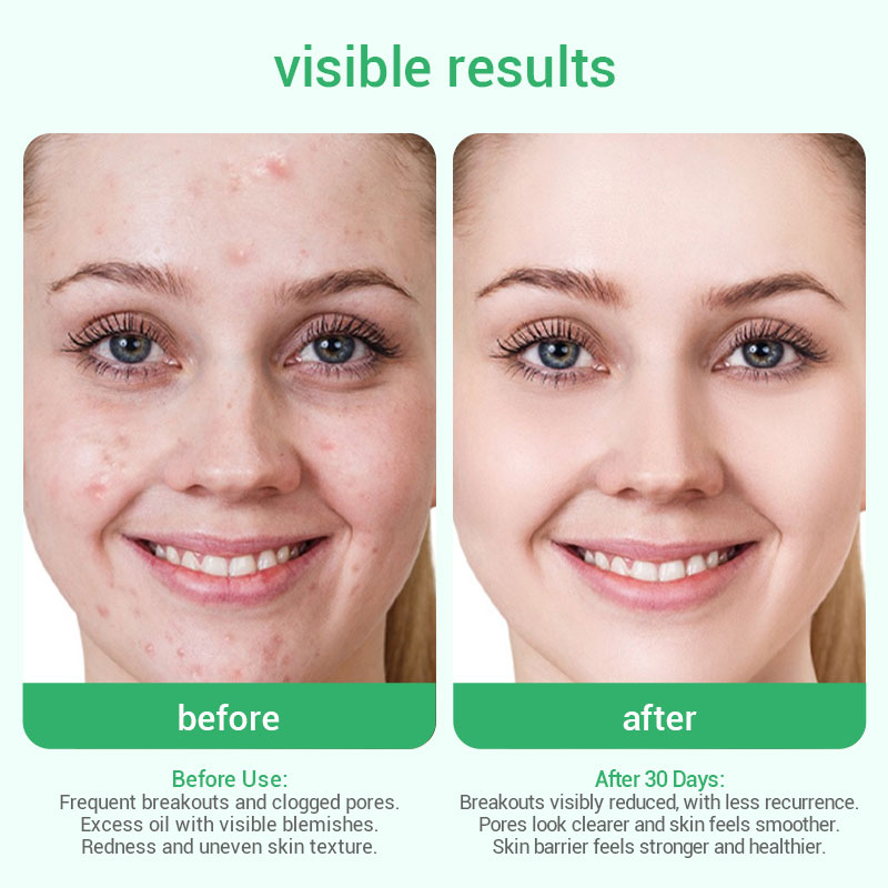 private label anti acne serum